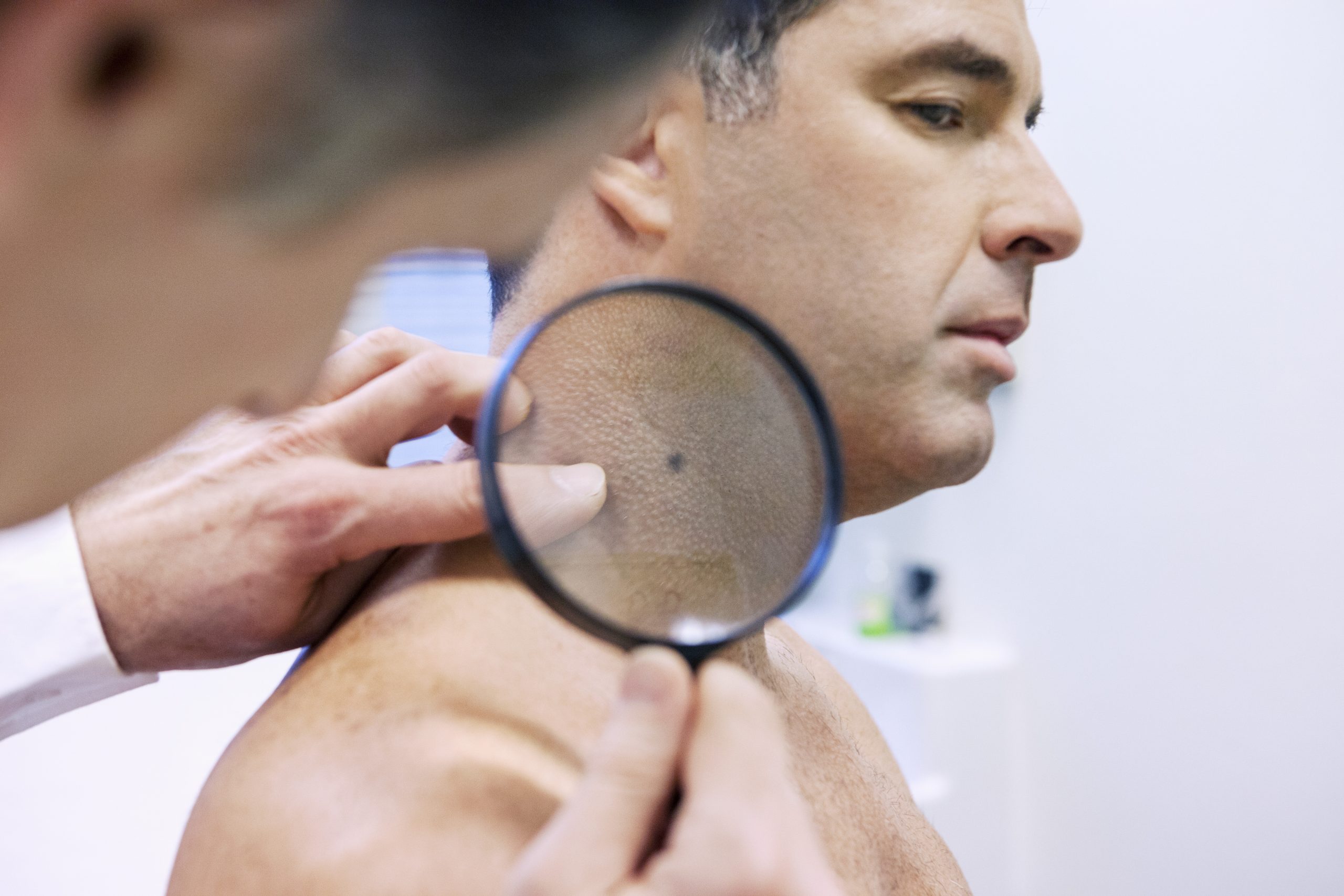 Skin Cancer