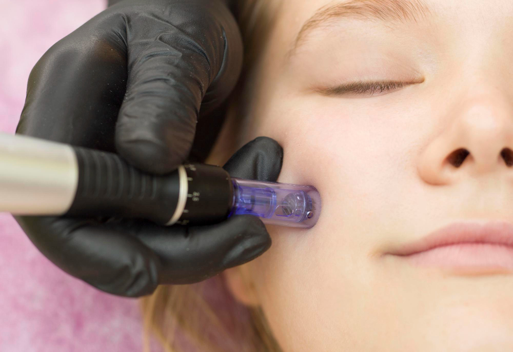 Radio Frequency Microneedling