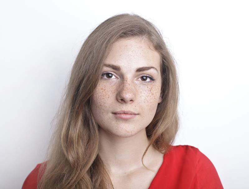Hyperpigmentation