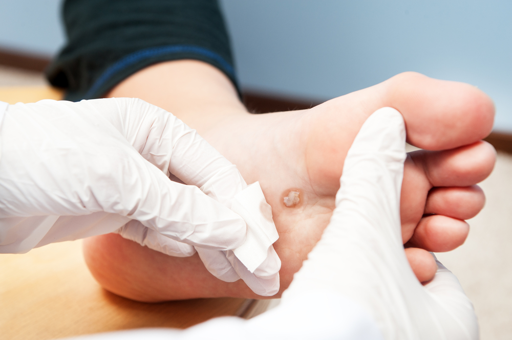 Warts & Molluscum Contagiosum